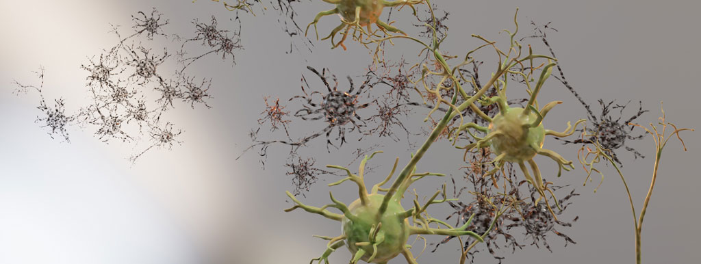 Koreaanse kruiden vertragen ALS