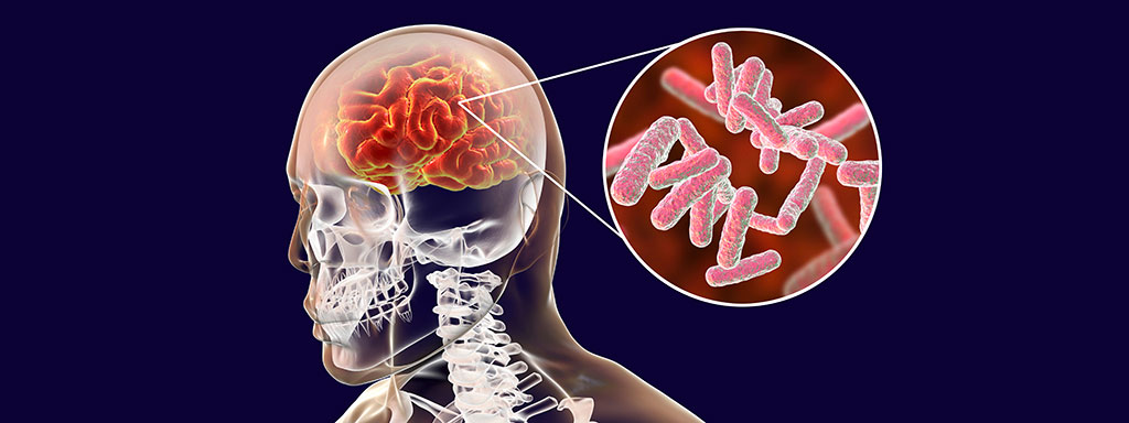 Bacteriën in de hersenen