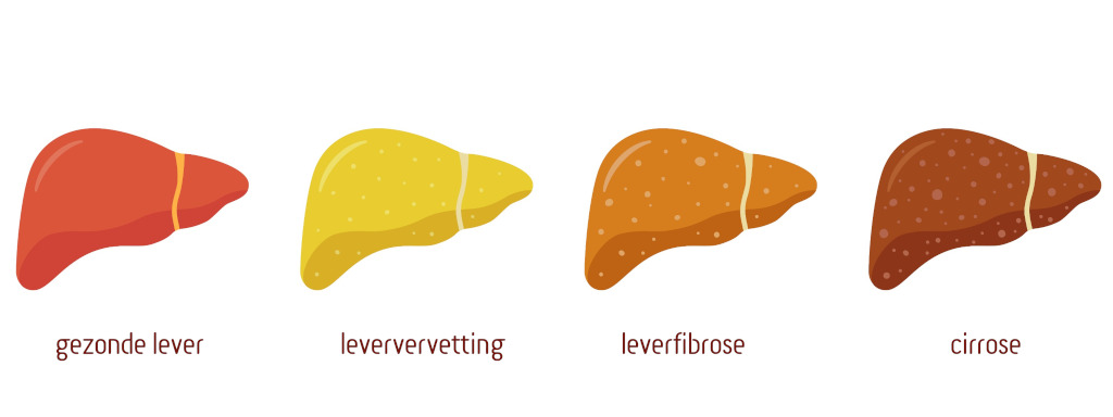 IJzertekort en vette lever