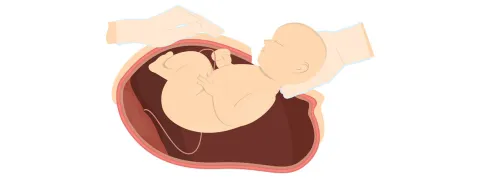 Keizersnede verhoogt kans op luchtweginfecties in eerste levensjaar