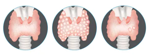 Curcumine, boswellia en spirulina in de strijd tegen schildklierknobbeltjes