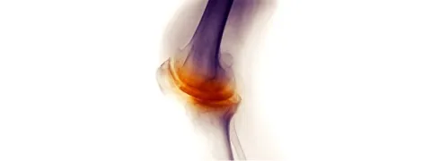Glucosamine en chondroïtine even doeltreffend als celecoxib