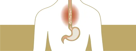 Medicatie tegen overgewicht veroorzaakt reflux