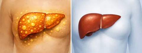 Ketogeen dieet verlaagt levervet sterk