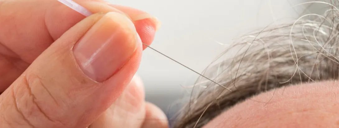 Acupunctuur en acupressuur kunnen pijn bij kanker verminderen