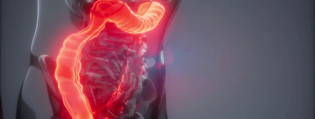 Fosfatidylcholine faalt bij colitis ulcerosa