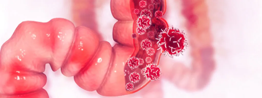 Diagnose darmkanker via urine