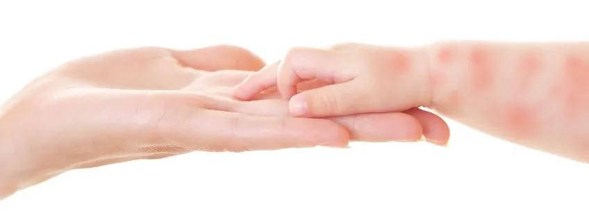 Vitamine D tegen eczeem