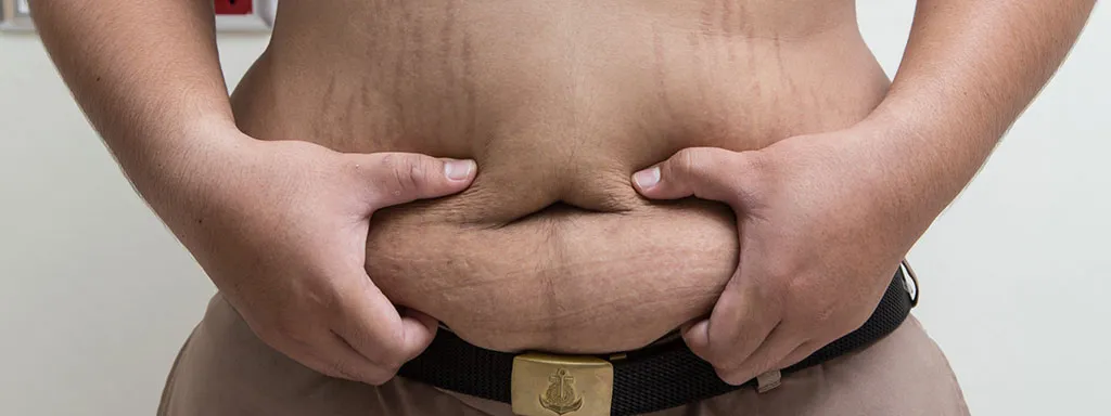 Effecten van gastric bypass verdwijnen