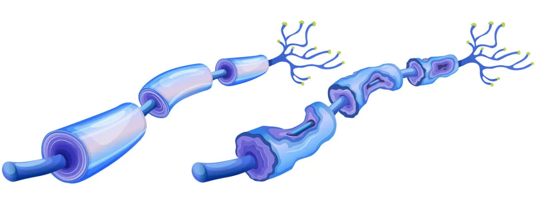 Omega-3 tegen neuropathie