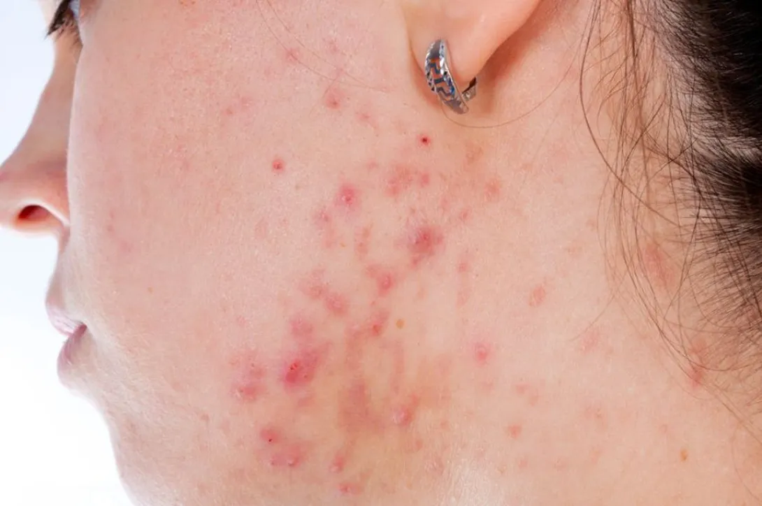 Vetzuren tegen acne