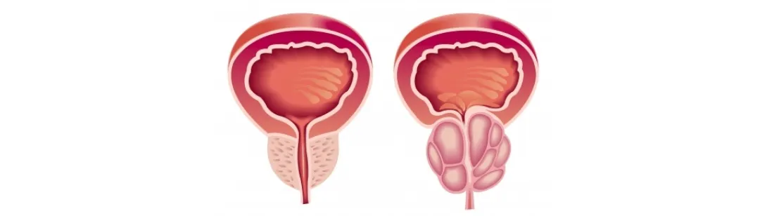 Zink nuttig bij prostatitis