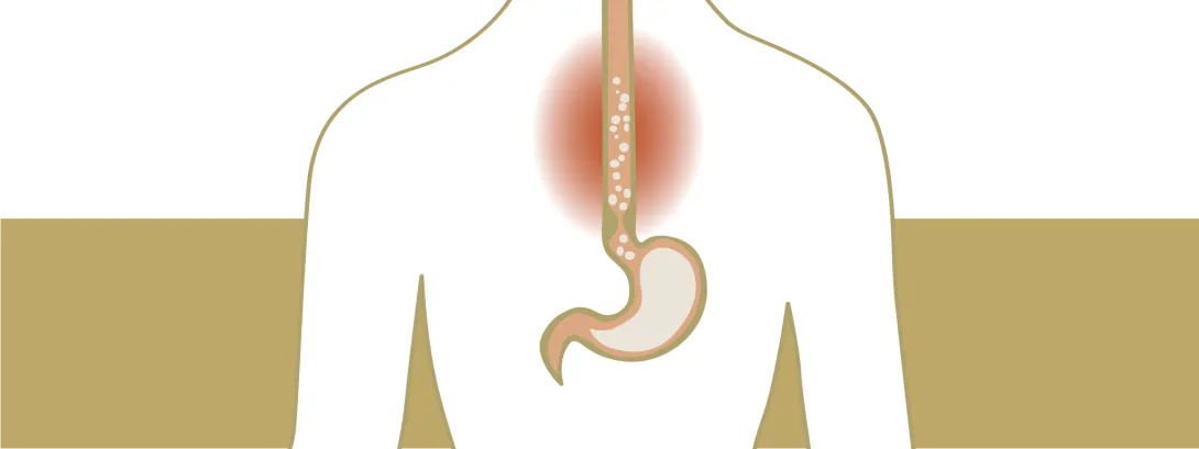 Medicatie tegen overgewicht veroorzaakt reflux