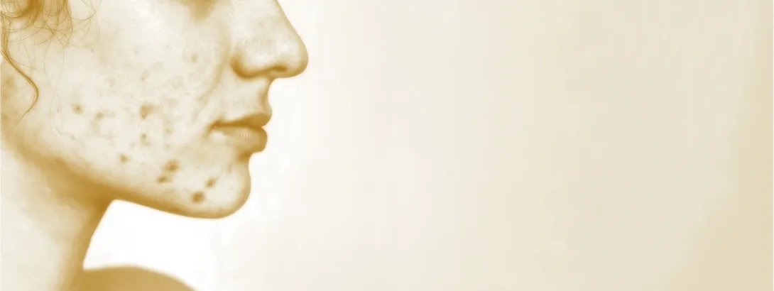 Acne, oxidatieve stress en metabole ontregeling